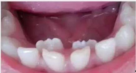 牙齿不齐吃瓜视频,揭秘矫正之路的酸甜苦辣